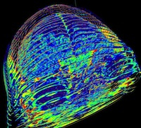 CT Scan of Brain